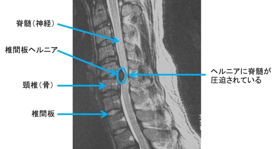 頸椎症 頸椎ヘルニア ストレートネック 頸椎捻挫