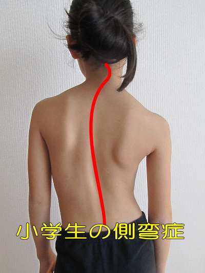 脊椎側弯症の整体